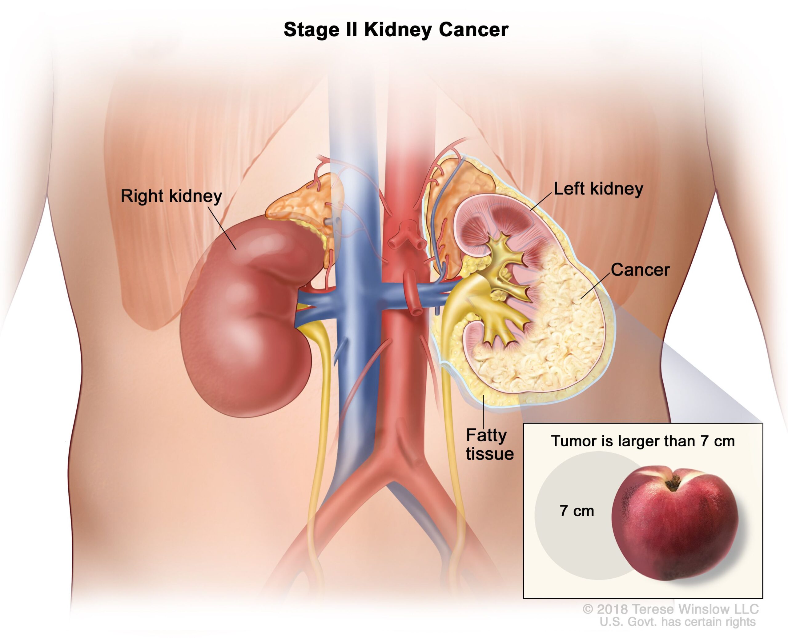 Renal cell carcinoma treatment