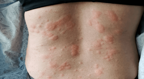 steroids for shingles